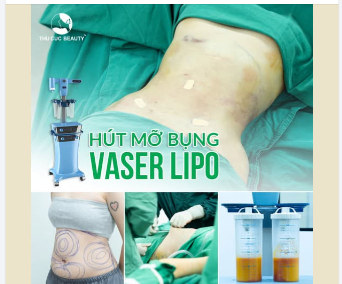 Hút 1 lần - Đẹp bền lâu cùng Vaser Lipo đang có mặt tại Thu Cúc