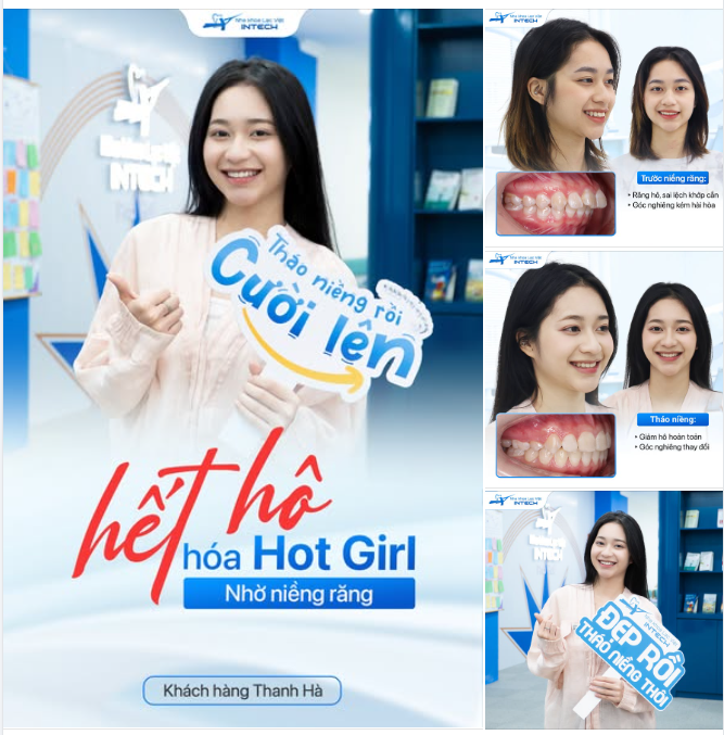 NIỀNG RĂNG HÔ - 18 THÁNG ĐỂ ĐỔI LẤY NỤ CƯỜI 10 ĐIỂM