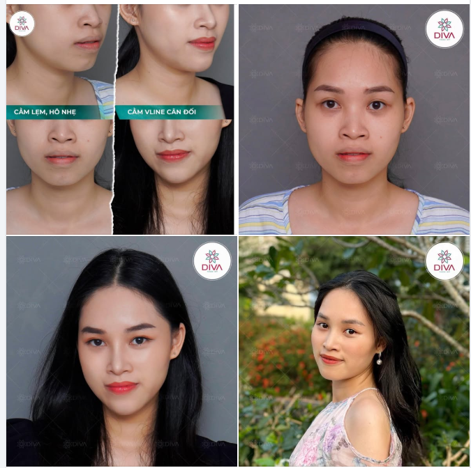 CẤY MỠ CẰM – “CHỮA” CẰM LẸM, TĂNG ĐỘ NHÔ, CHO MẶT V-LINE TỰ NHIÊN