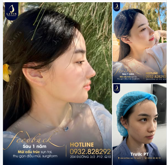 ĐỔI DÁNG MŨI, ĐỔI THẦN THÁI