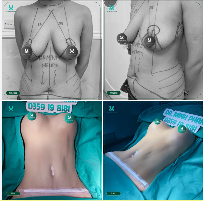 COMBO ĐẠI TRÙNG TU BODY CHO MẸ BỈM