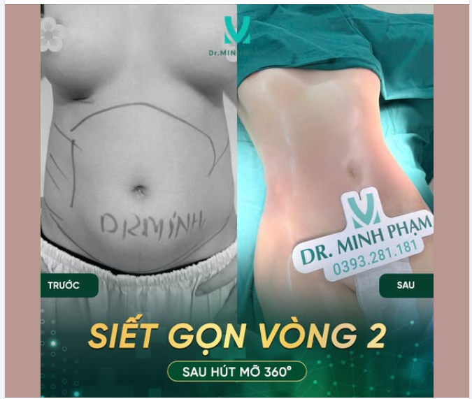 HÚT MỠ 360° – EO GỌN HƠN, BODY CUỐN HƠN