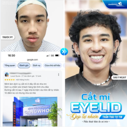 CẮT MÍ EYELID – ĐẸP TỰ NHIÊN, THẦN THÁI TỰ TIN