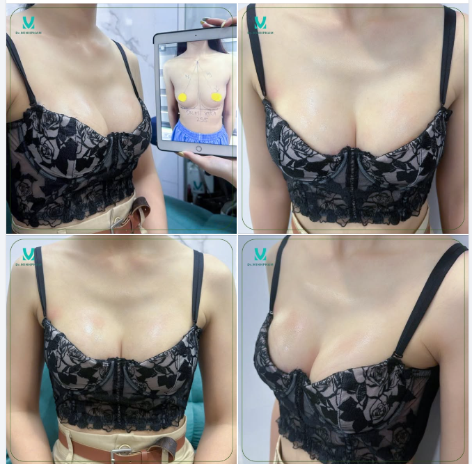 TÁI KHÁM SAU NÂNG NGỰC – KHI SỰ TỰ TIN DẦN TRỞ LẠI