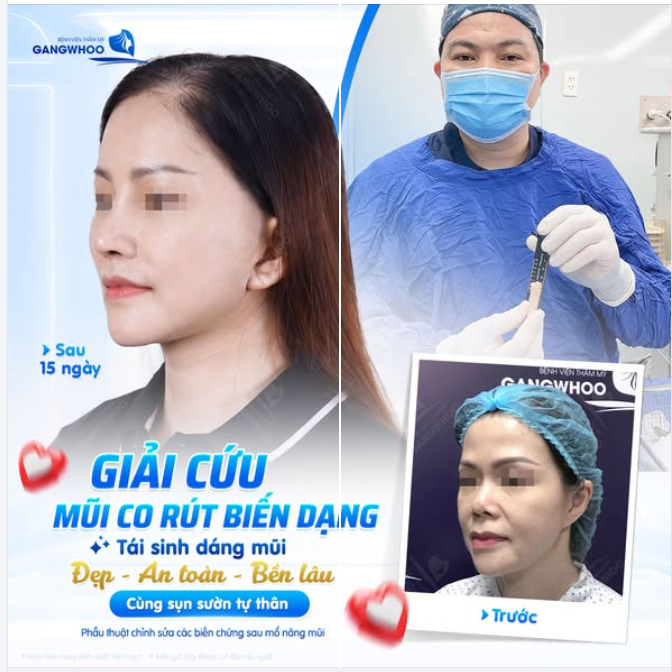 GIẢI CỨU MŨI CO RÚT BIẾN DẠNG