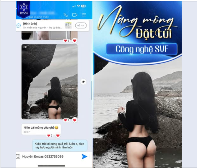 Đặt túi độn kết hợp mỡ tự thân và yếu tố SVF tạo nên vòng 3 cực phẩm