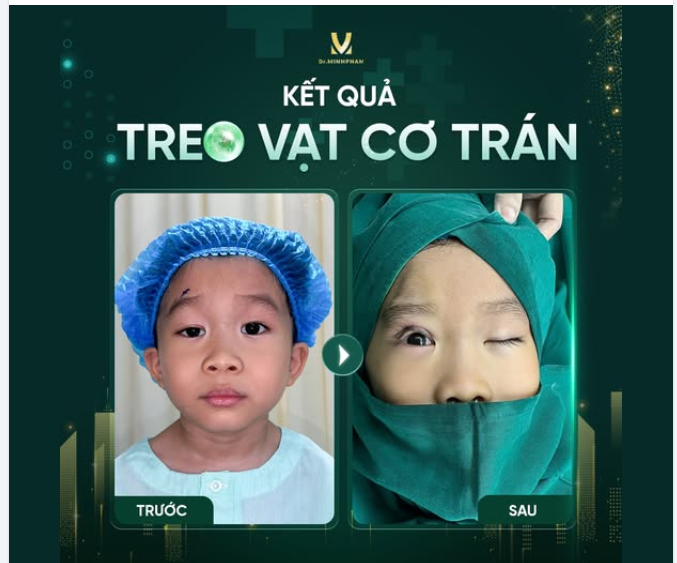 Bé Bảo Long có tình trạng sụp mi bẩm sinh khiến tầm nhìn bị hạn chế và tự ti trong cuộc sống