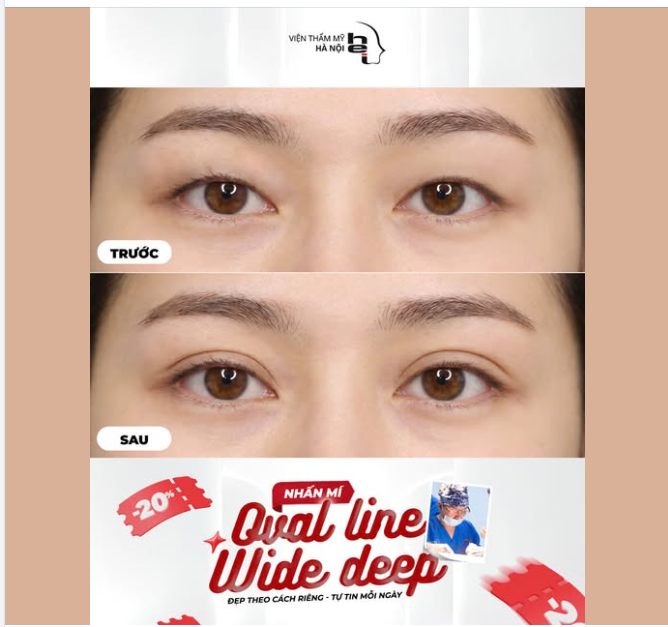 NHẤN MÍ OVAL LINE WIDE DEEP – MÍ ĐẸP CHUẨN TỶ LỆ VÀNG