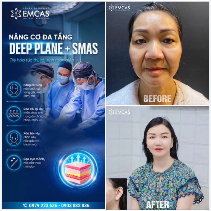 NÂNG CƠ ĐA TẦNG DEEP PLANE VÀ SMAS