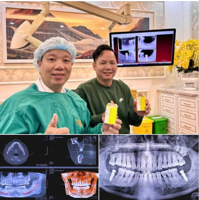 ANH KHỞI TỪ BA LAN VỀ VIỆT NAM CẮM TRỤ IMPLANT