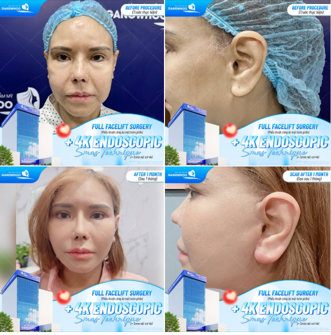 PHẪU THUẬT CĂNG DA MẶT TOÀN PHẦN + SMAS NỘI SOI 4K