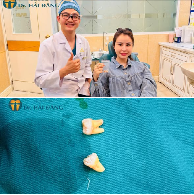 NHỔ LIỀN 2 RĂNG KHÔN NHẸ NHÀNG – NHANH CHÓNG