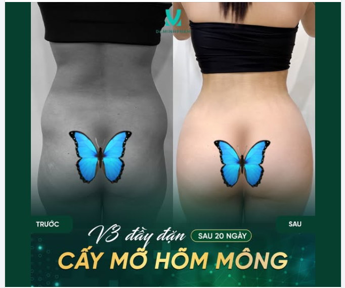 V3 ĐẦY ĐẶN HƠN SAU 20 NGÀY CẤY MỠ MÔNG