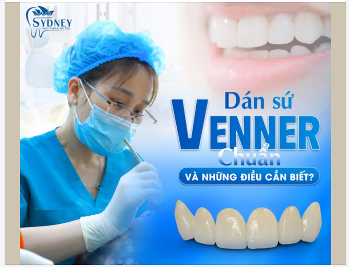 DÁN SỨ VENEER CHUẨN VÀ NHỮNG ĐIỀU CẦN BIẾT