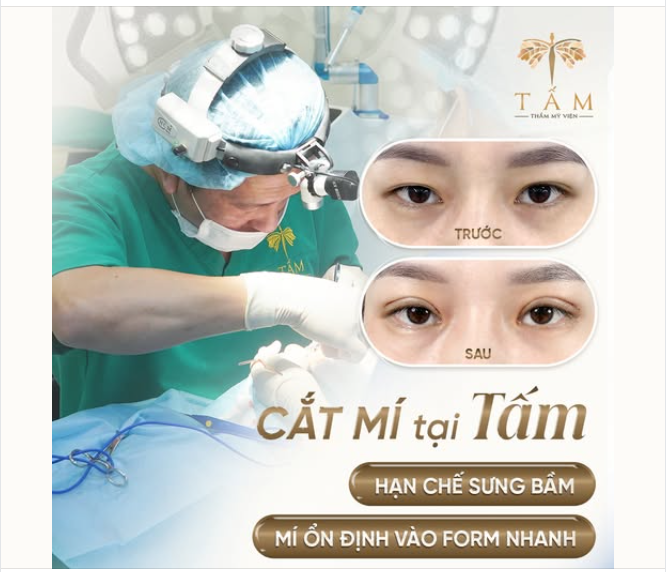 CẮT MÍ TẠI TẤM – ĐẸP TỰ NHIÊN, HẠN CHẾ SƯNG BẦM
