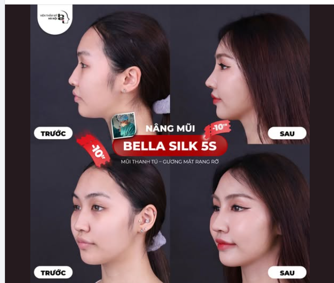 MŨI ĐẸP THỜI THƯỢNG – ĐIỂM NHẤN HOÀN HẢO CHO GƯƠNG MẶT
