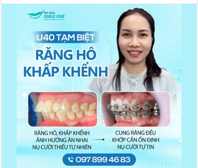 32 TUỔI MỚI BẮT ĐẦU NIỀNG RĂNG – CÓ MUỘN KHÔNG?