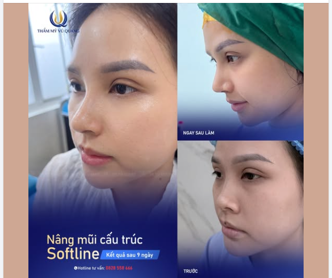 Cao sang, mềm mại chỉ sau 10 ngày Nângmũi cấu trúc Softline
