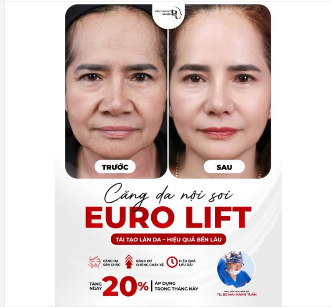 CĂNG DA NỘI SOI EURO LIFT không chỉ đơn thuần là làm trẻ hoá gương mặt mà nó còn mang lại nhiều lợi ích về sức khoẻ cho phụ nữ trung niên.