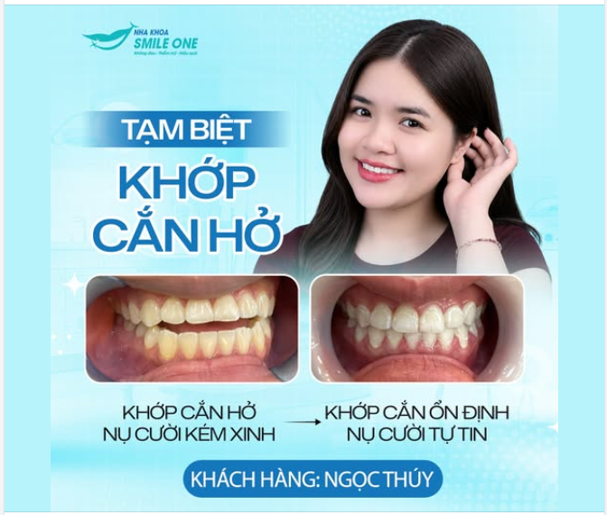KHÉP LẠI KHỚP CẮN HỞ SAU 18 THÁNG NIỀNG RĂNG MẮC CÀI