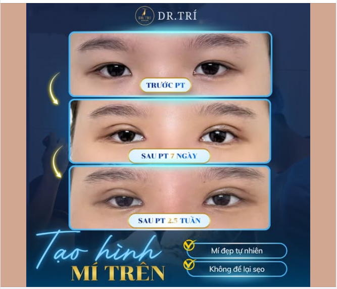 Mí đẹp tự nhiên – Tự tin tỏa sáng!