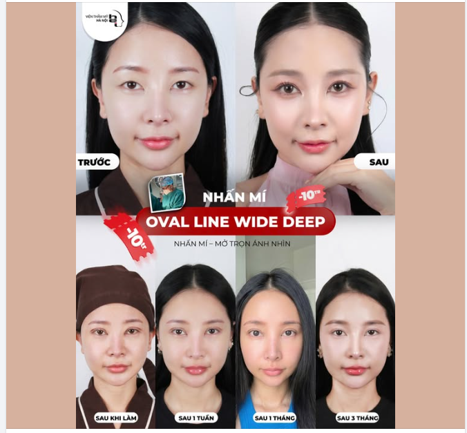 MUỐN MẮT 2 MÍ NHƯNG SỢ ĐAU, SỢ SẸO?