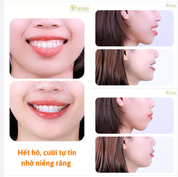 HÀNH TRÌNH THAY ĐỔI ĐỂ CHẠM TỚI NỤ CƯỜI RẠNG RỠ