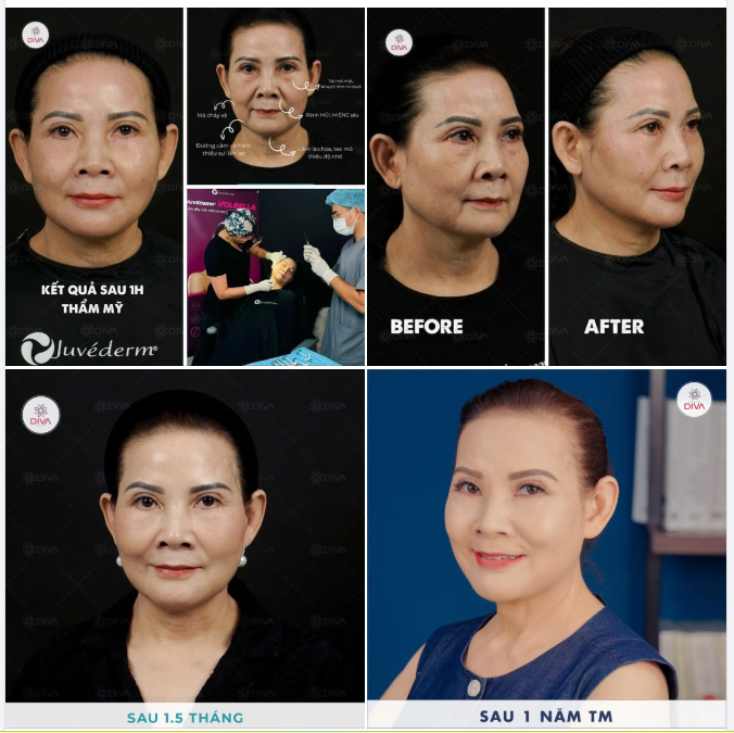 FILLER KỸ THUẬT MD CODES - CẢI THIỆN SỰ C.HẢY X.Ệ VÀ LÃO HÓA HIỆU QUẢ MÀ KHÔNG ẢNH HƯỞNG ĐẾN BIỂU CẢM KHUÔN MẶT