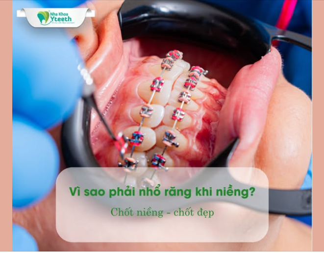 Nhổ răng khi niềng không đáng sợ nếu được chỉ định đúng. Việc này giúp bạn có hàm răng đều, khớp cắn chuẩn và gương mặt hài hòa hơn.
