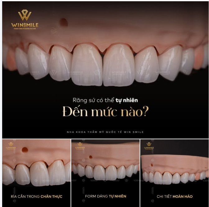 RĂNG SỨ CÓ THỂ TỰ NHIÊN ĐẾN MỨC NÀO?