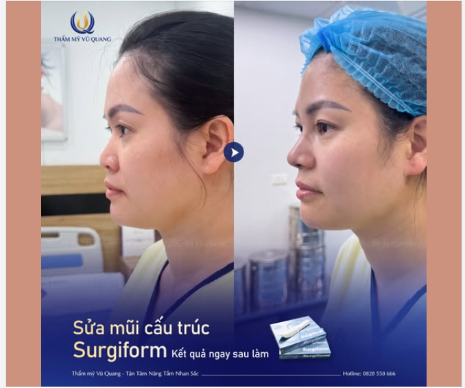 GIẢI CỨU DÁNG MŨI HỎNG SAU 5 NĂM THỰC HIỆN