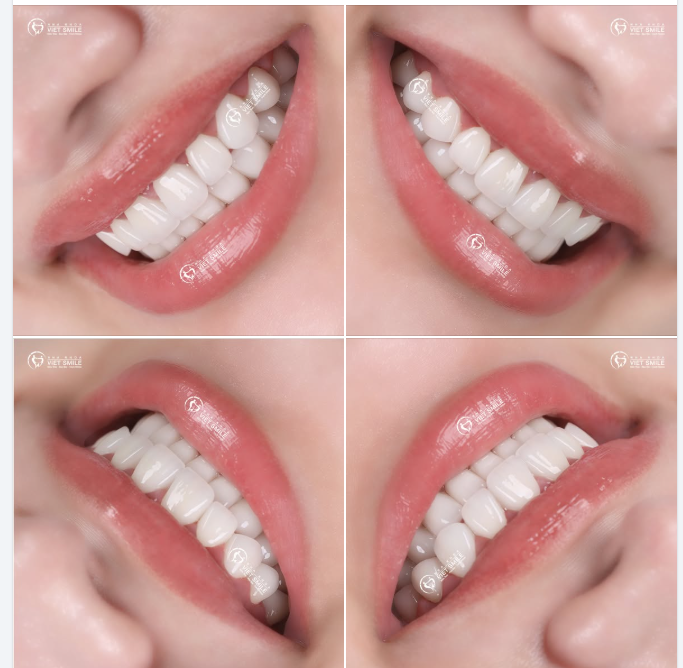 ĐẲNG CẤP SỨ ORODENT – KIỆT TÁC CỦA NỤ CƯỜI