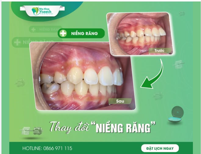 Đây không chỉ là thay đổi về mặt thẩm mỹ mà còn góp phần nâng cao sức khỏe răng miệng lâu dài.