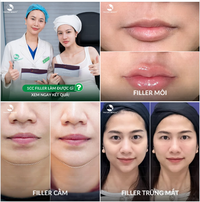 Nếu chỉ có 1cc filler, nên tiêm vào đâu để lột xác ngoạn mục?