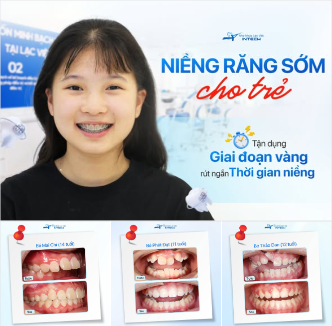 NIỀNG RĂNG ĐÚNG LÚC - TƯƠNG LAI HẠNH PHÚC