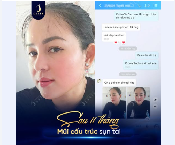 FEEDBACK XỊN SAU 11 THÁNG NÂNG MŨI CẤU TRÚC SỤN TAI