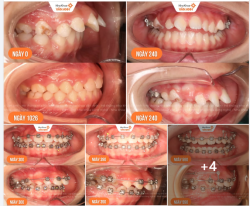 10 tuổi đã nên niềng răng chưa?