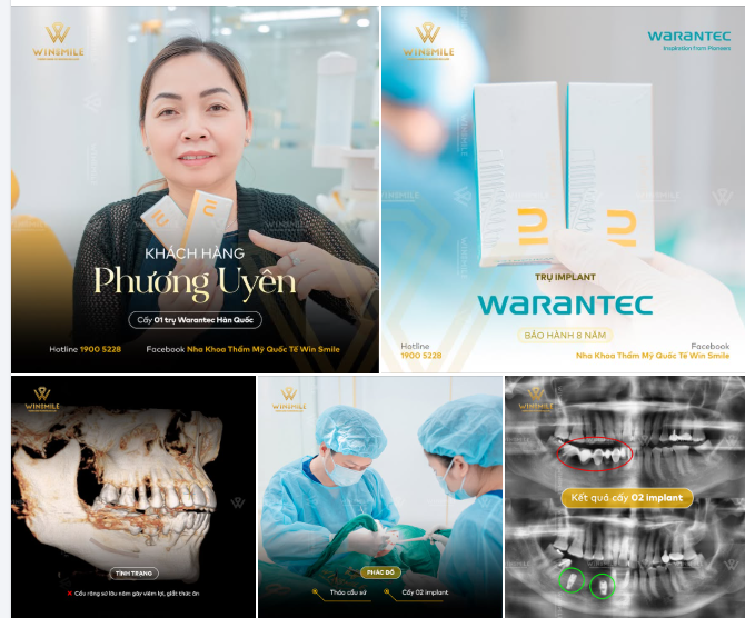 THAY THẾ CẦU RĂNG SỨ BẰNG IMPLANT: GIẢI PHÁP ĂN NHAI CHẮC CHẮN VÀ THOẢI MÁI HƠN MỖI NGÀY