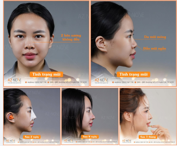 Dáng mũi Sline cao vừa, đầu mũi tròn nhẹ là lựa chọn của nhiều khách hàng yêu thích vẻ đẹp nhẹ nhàng, trẻ trung và giữ được nét riêng trên gương mặt.