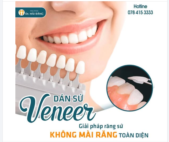DÁN SỨ VENEER – ĐẸP TỰ NHIÊN, HẠN CHẾ MÀI RĂNG