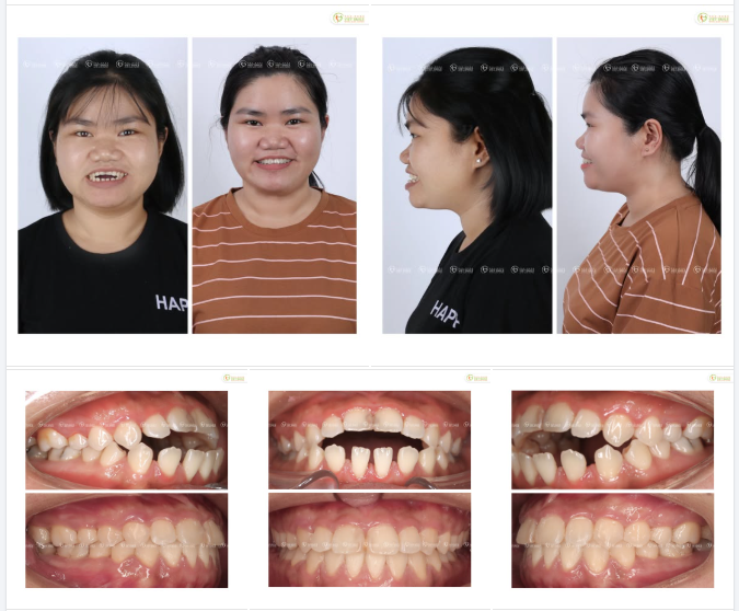 KHỚP CẮN HỞ – KHOẢNG TRỐNG KHIẾN BẠN MẤT ĐI SỰ TỰ TIN