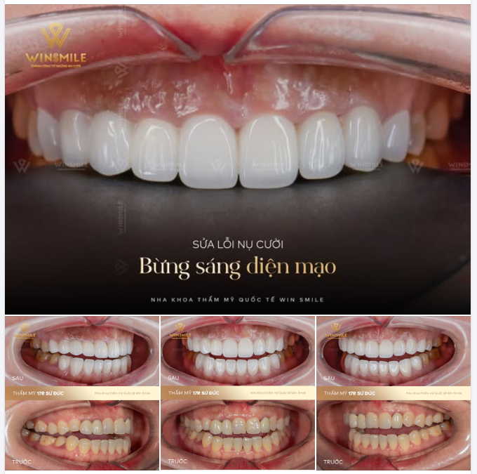 SỬA LỖI NỤ CƯỜI - BỪNG SÁNG DIỆN MẠO