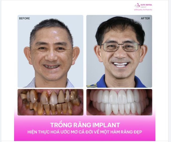 TRỒNG RĂNG IMPLANT - KHÉP LẠI THỜI GIAN THIẾU TỰ TIN VÌ HÀM RĂNG XUỐNG CẤP