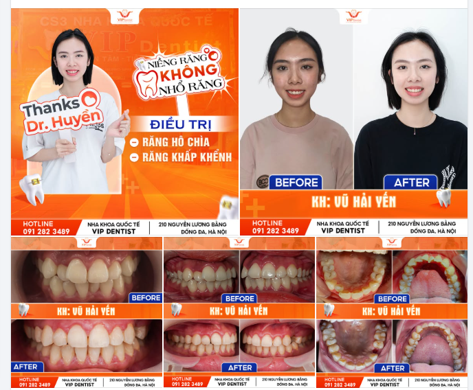 KẾT QUẢ NIỀNG RĂNG KHÔNG NHỔ RĂNG – TỰ TIN CƯỜI XINH CÙNG VŨ HẢI YẾN