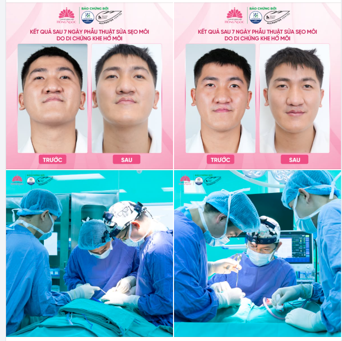 KHI VẾT SẸO TRÊN MÔI KHÔNG CHỈ ẢNH HƯỞNG THẨM MỸ