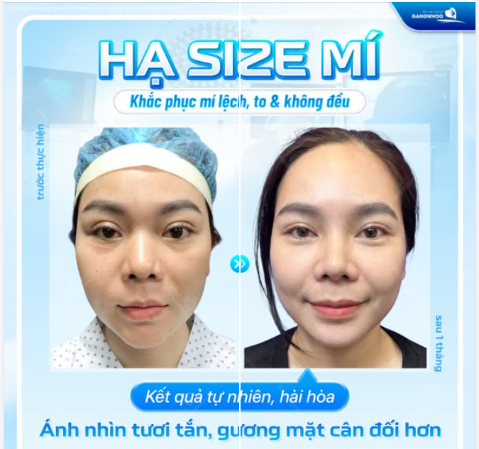 HẠ SIZE MÍ – KHẮC PHỤC MÍ LỆCH, TO & KHÔNG ĐỀU
