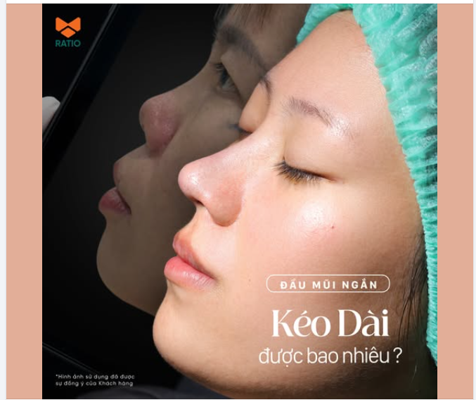 Trong nâng mũi, với những trường hợp đầu mũi ngắn,  việc kéo dài đầu mũi có thể giúp gương mặt hài hòa hơn.