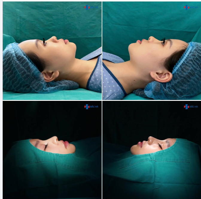 NÂNG MŨI SLINE GIẢM ĐẾN 40% – THẤY RÕ SỰ KHÁC BIỆT NGAY SAU THỰC HIỆN