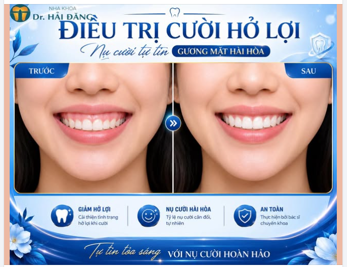 CƯỜI HỞ LỢI – ĐỪNG ĐỂ NỤ CƯỜI LÀM BẠN MẤT TỰ TIN