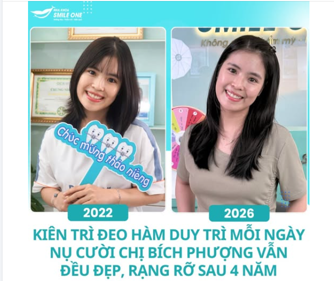 KHÔNG ĐEO HÀM DUY TRÌ – RĂNG CÓ THỂ LỆCH LẠI SAU VÀI NGÀY